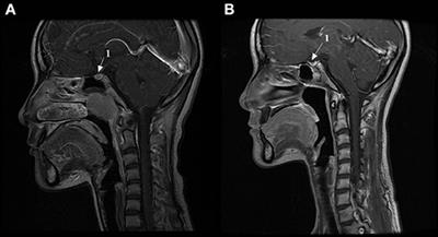 Decreased Pituitary Height and Stunted Linear Growth After Radiotherapy in Survivors of Childhood Nasopharyngeal Carcinoma Cases